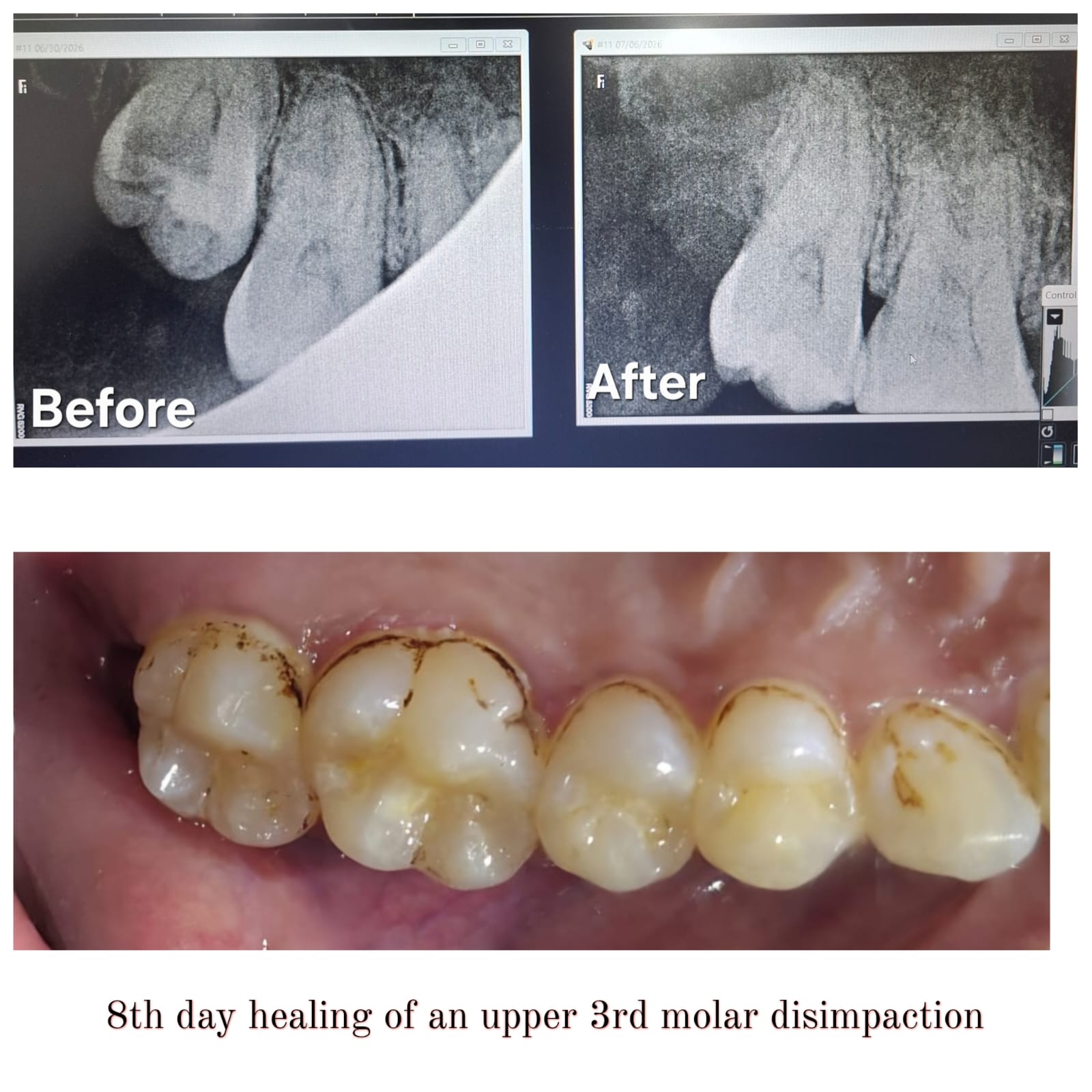 Before and After Smile Transformation Case 6