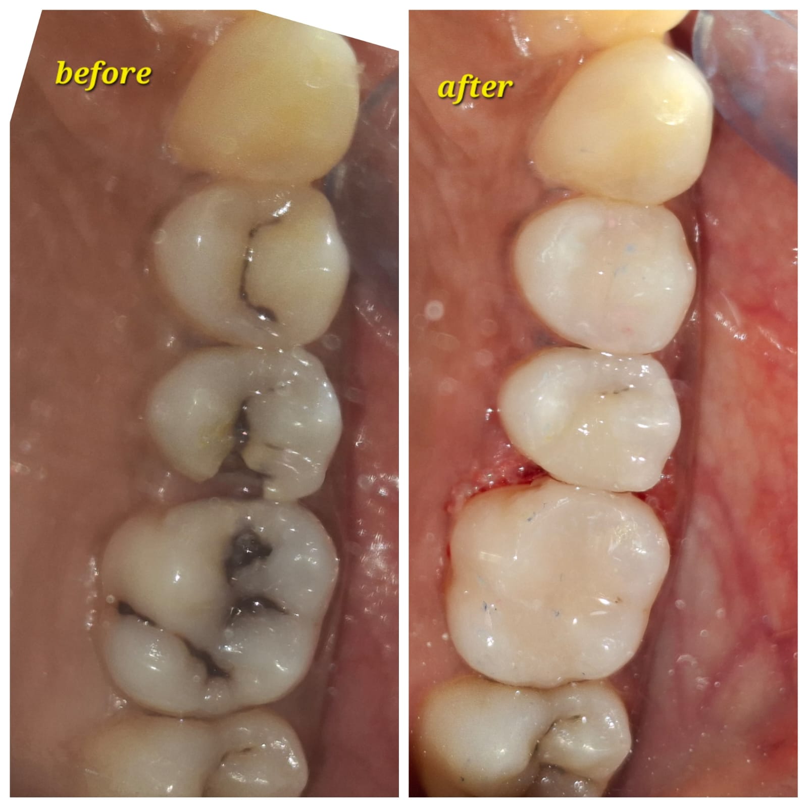 Before and After Smile Transformation Case 1