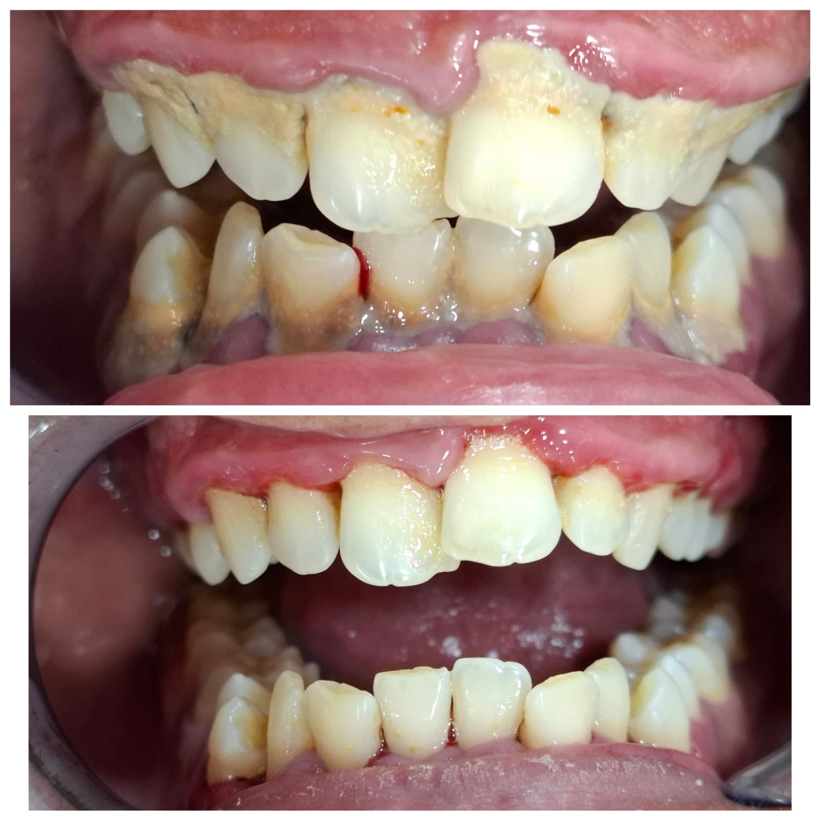 Before and After Smile Transformation Case 2