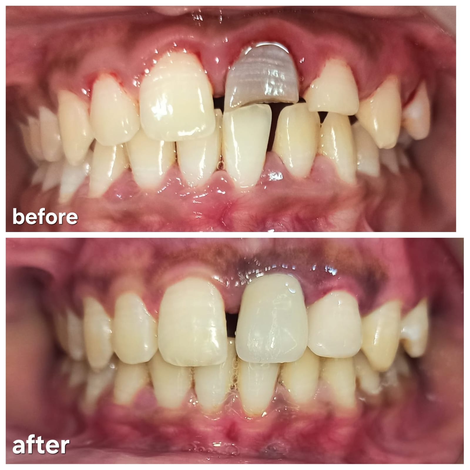 Before and After Smile Transformation Case 5